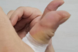 终于竖起了“点赞”的大拇指  ——湖医附一医院中医一招治愈腱鞘炎