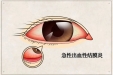 健康提醒 ： 近期“红眼病”高发，如何预防是关键