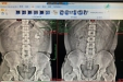 【卓越医疗在湖一】 肾铸型结石不用怕，无创碎石取石技术还您肾健康