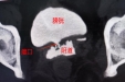 【卓越医疗在湖一】 复杂性膀胱阴道瘘：困扰桂女士半年的“漏尿”痛楚没啦！
