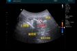 【卓越医疗在湖一】 湖医附一医院成功开展怀化首例床旁肌骨超声引导治疗三叉神经痛