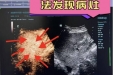 精准“狙击”病灶，微创“探明”病因——超声引导下联合超声造影+同轴针技术突破肺、肝占位诊疗瓶颈
