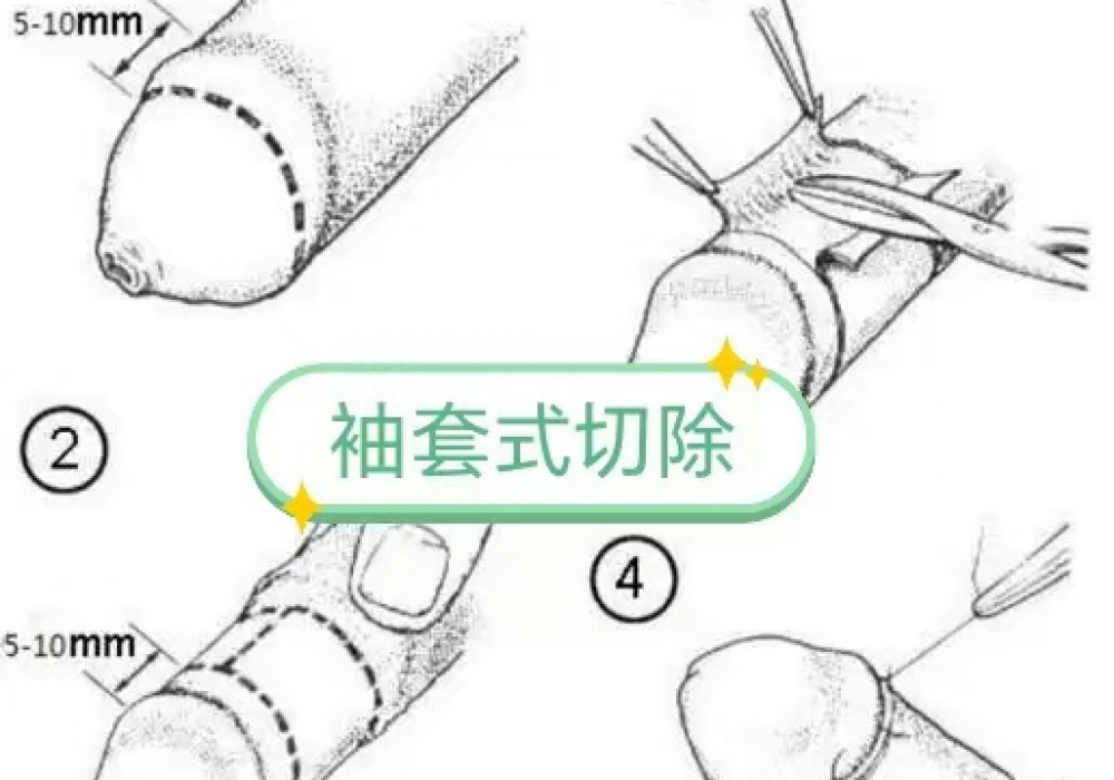 【特色技术】告别盲切，开启男科显微技术精工新局面——显微镜下袖套式包皮环切术